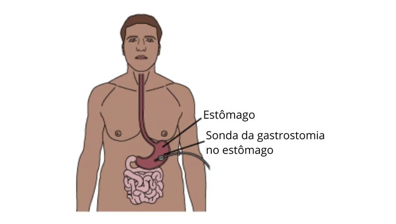 Imagem ilustrativa de um homem, mostrando sonda da gastronomia no estômago