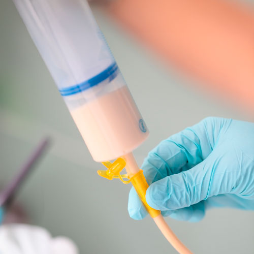 Profissional com luvas azuis manuseando sonda de gastrostomia conectada a frasco com dieta líquida para alimentação enteral.