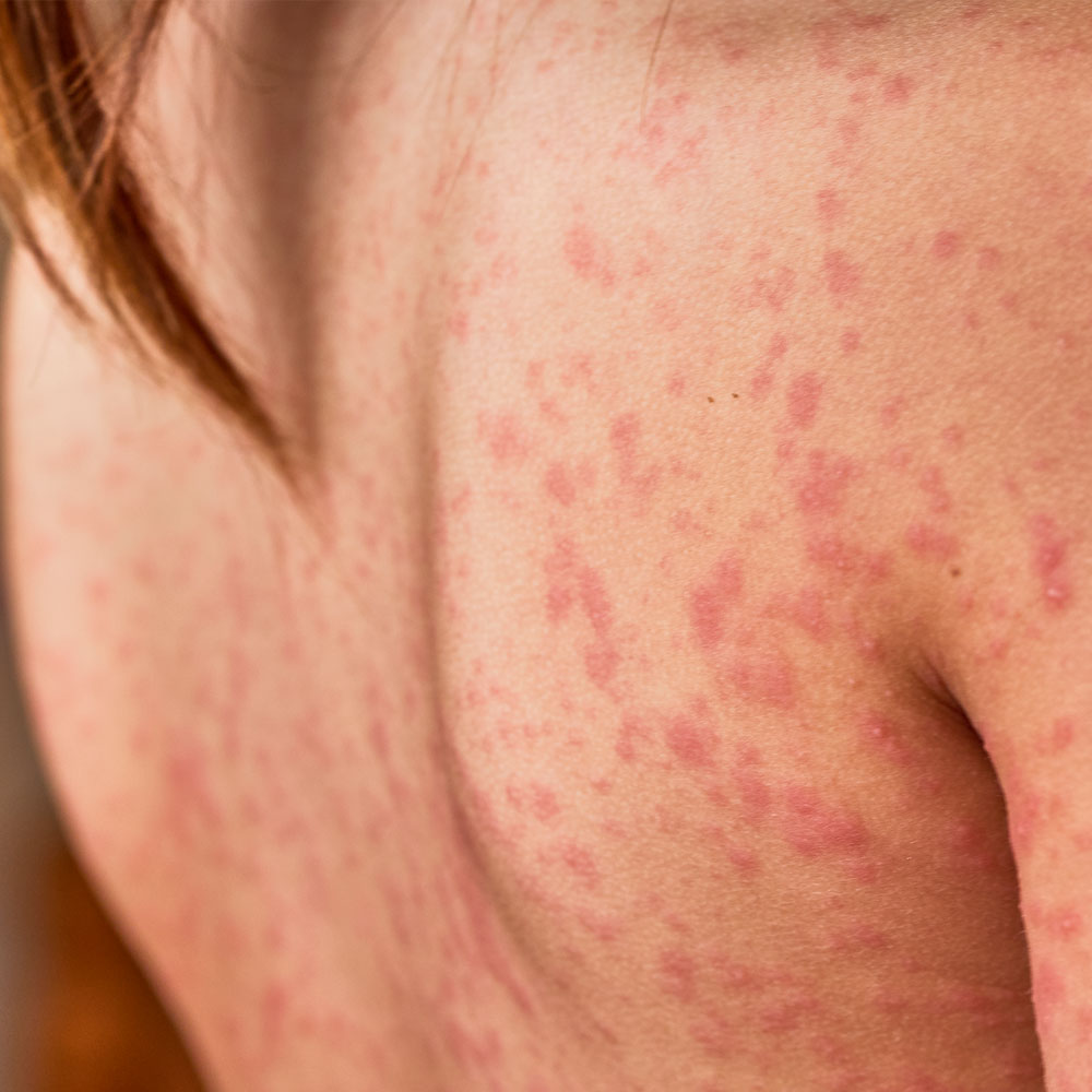 Close no dorso de uma pessoa com manchas avermelhadas na pele, indicando possível infecção, alergia ou irritação cutânea.