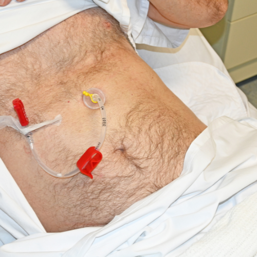 Paciente em ambiente hospitalar com sonda de gastrostomia abdominal, utilizada para alimentação direta ao estômago.