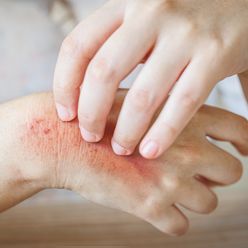 Mão com área avermelhada e irritada sendo coçada, sugerindo inflamação ou possível infecção cutânea.