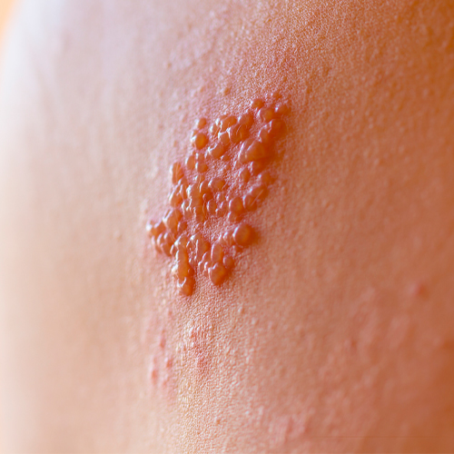 Lesão cutânea com pequenas bolhas agrupadas sobre pele avermelhada, característica de herpes-zóster.