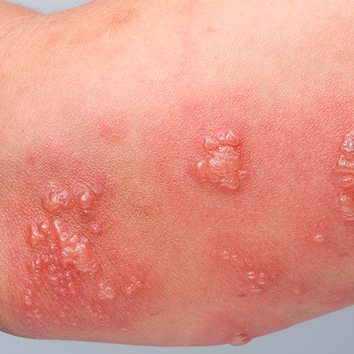 Pele com lesões avermelhadas e bolhas agrupadas, características de irritação ou infecção cutânea.